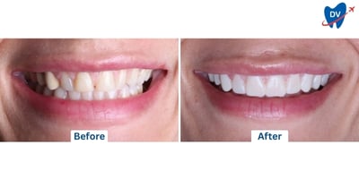 Teeth whitening in Dominican Republic: Before and After