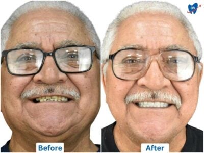 Before and after of dental veneers in Los Algodones