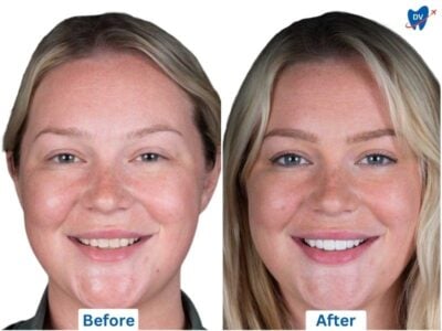 Before and After of porcelain veneers in Los Algodones