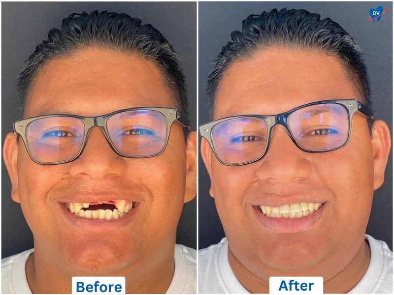 Dental Implant Restoration in Tijuana