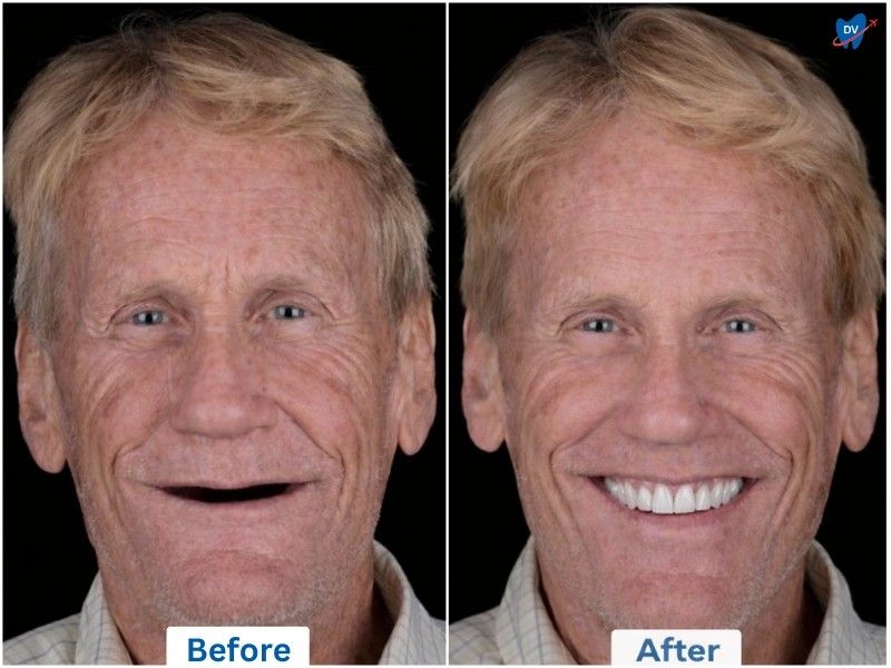 Dental Implant Restoration in Nogales