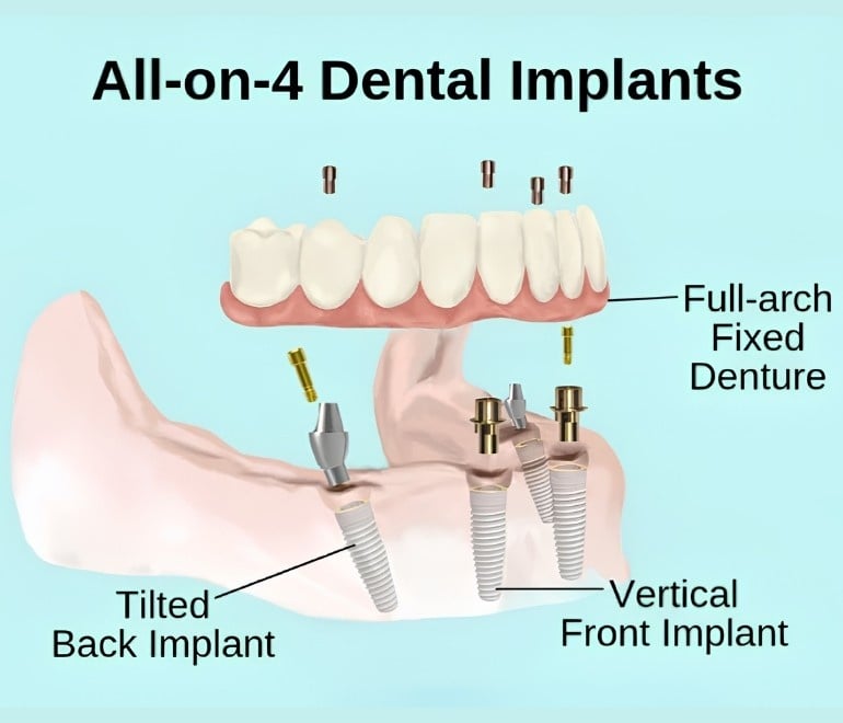 All-on-4 dental implants, Turkey