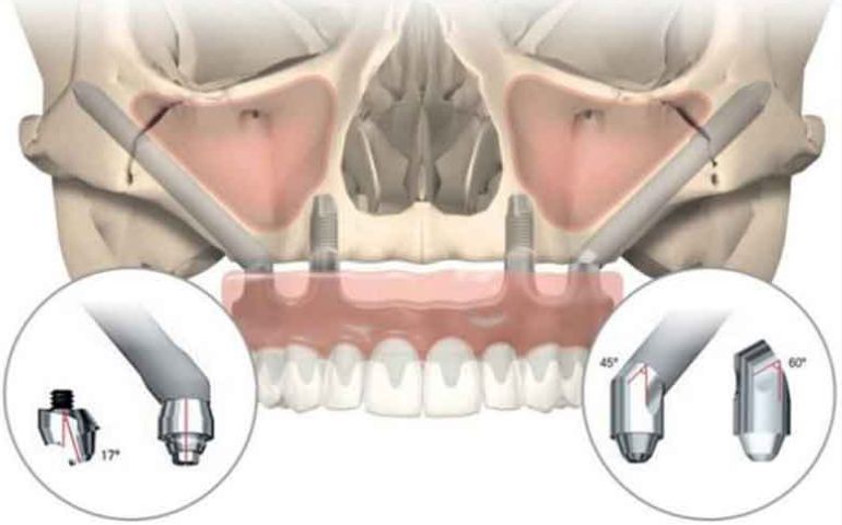 Components of a Zygomatic Implant