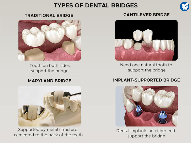 Types of dental bridge