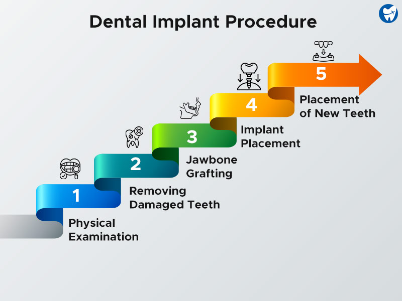 Stepwise placement of Dental Implant in Cali, Colombia
