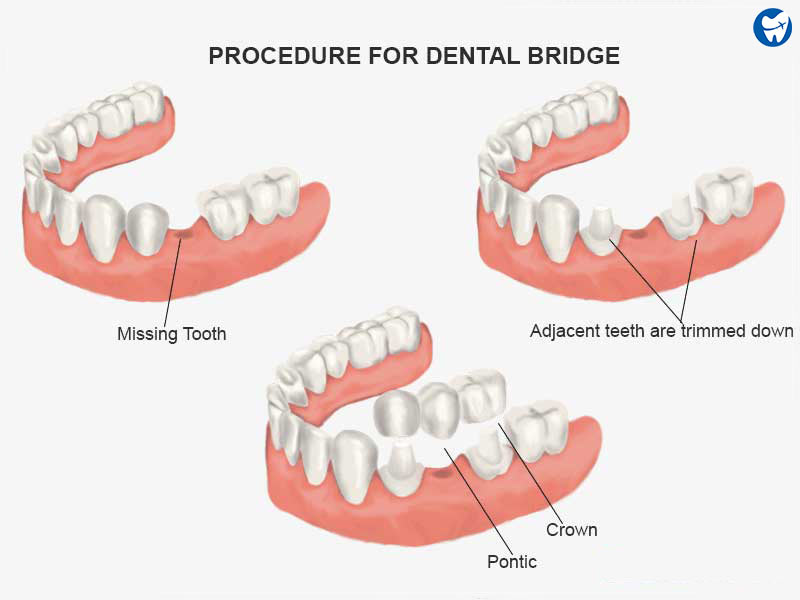 Dental Bridge Procedure 