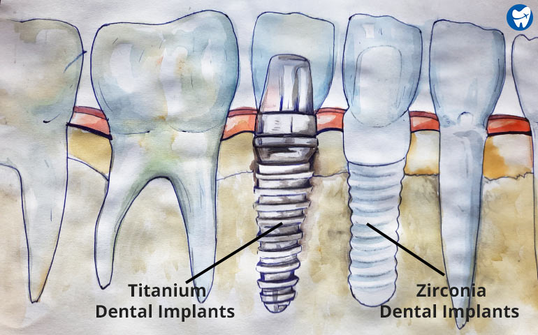 Implantes de titanio y zirconia