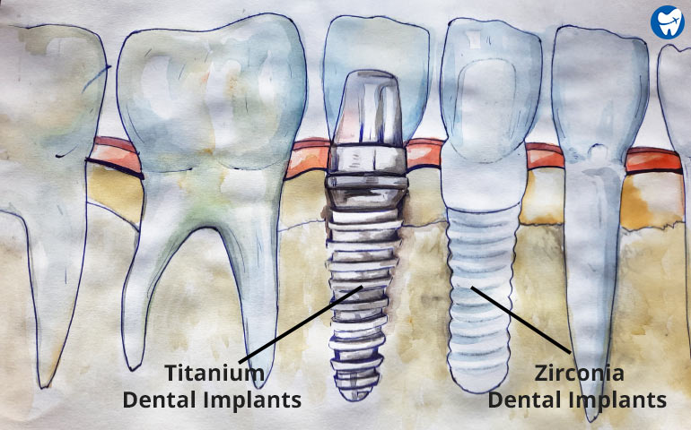 Zirconium Implants in Mexico