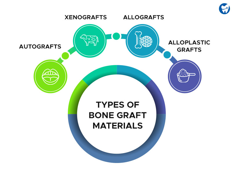 Types of Bone Graft Materials